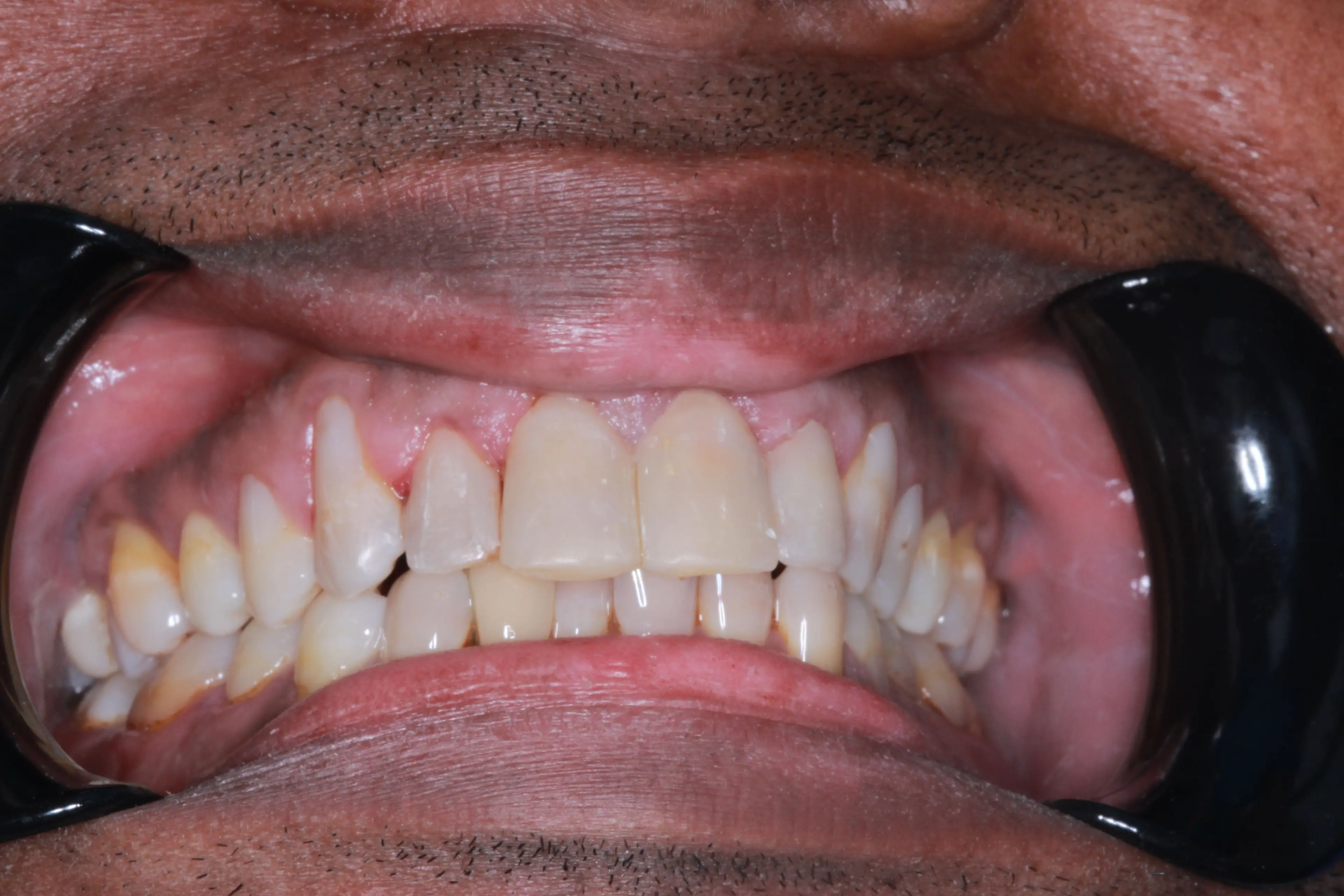 Successful composite bonding